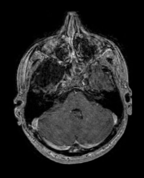 File:Arachnoid cyst- extremely large (Radiopaedia 68741-78451 Axial T1 C+ 22).jpg