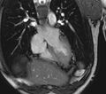 Arrhythmogenic right ventricular cardiomyopathy (Radiopaedia 39806-42237 D 123).jpg