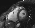 Arrhythmogenic right ventricular cardiomyopathy (Radiopaedia 69564-79464 short axis cine 149).jpg