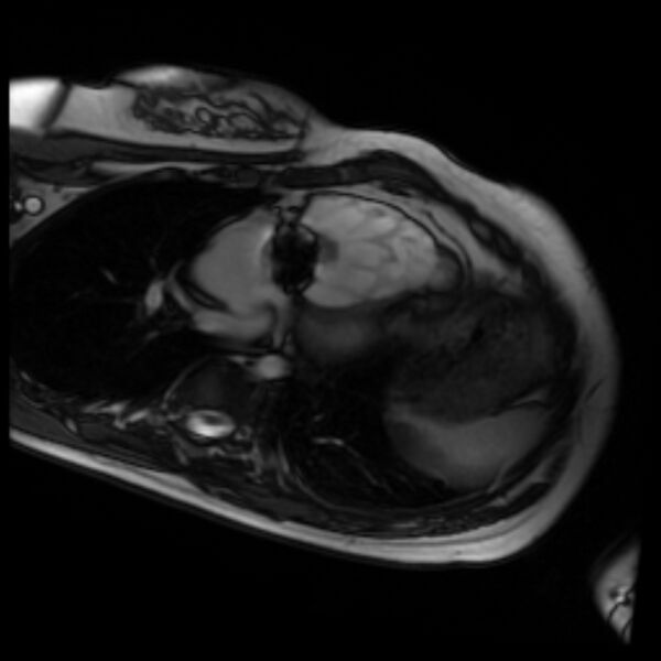 File:Arrhythmogenic right ventricular cardiomyopathy (Radiopaedia 87505-103850 4ch Cine SSFP 92).jpg
