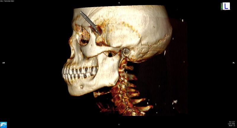 File:Arrow injury to the head (Radiopaedia 75266-86388 3D horizontal 18).jpg