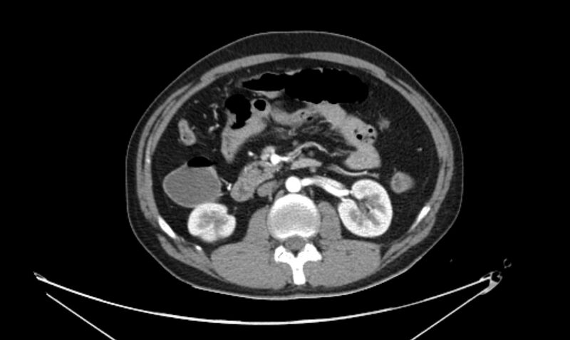 File:Arterial occlusive mesenteric ischemia (Radiopaedia 84641-100060 A 59).jpg
