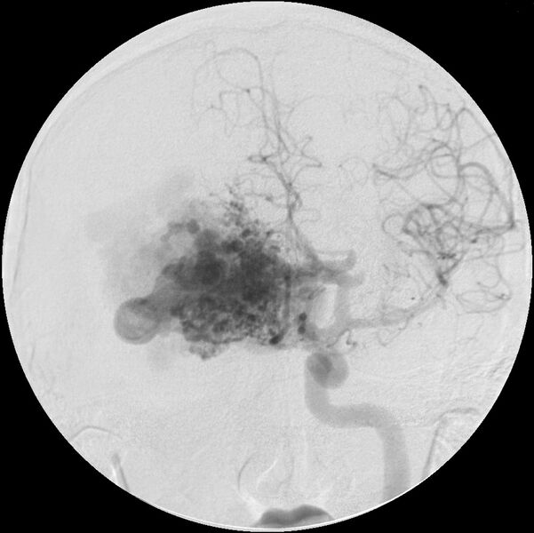 File:Arteriovenous malformation - cerebral (Radiopaedia 4000-6539 A 1).jpg