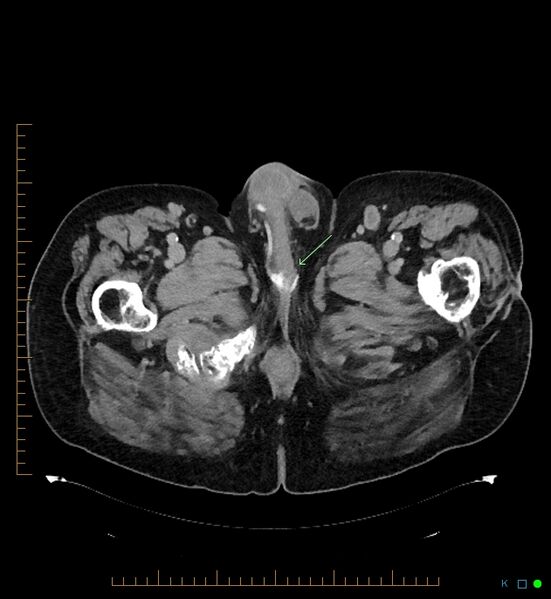 File:Artificial urethral sphincter (Radiopaedia 46937-51464 A 15).jpg
