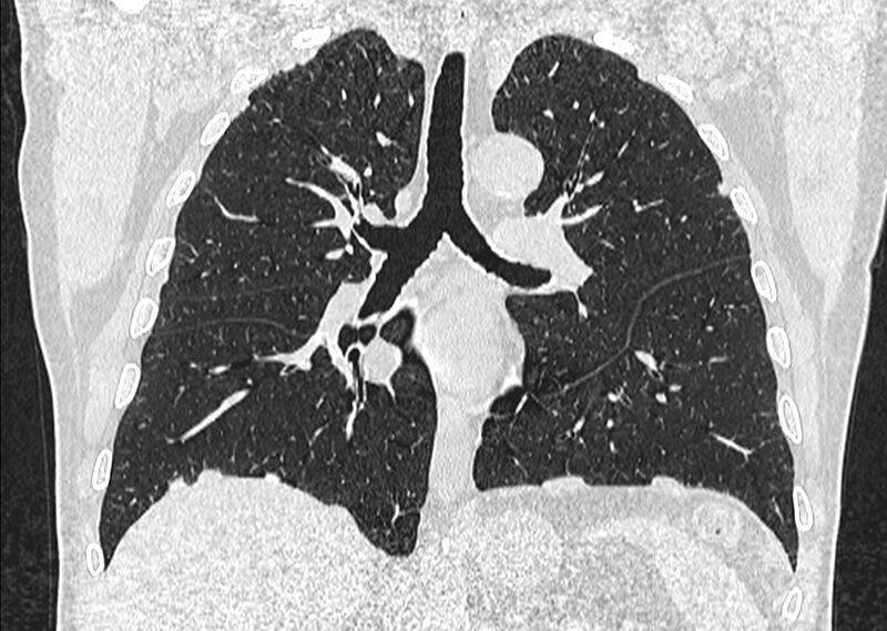 File:Asbestos pleural placques (Radiopaedia 57905-64872 Coronal lung window 158).jpg