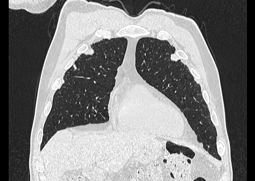 Asbestos pleural placques (Radiopaedia 57905-64872 Coronal lung window 55).jpg