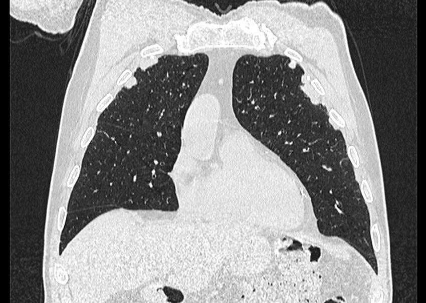 Asbestos pleural placques (Radiopaedia 57905-64872 Coronal lung window 72).jpg
