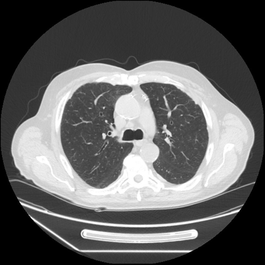 Asbestosis complicated by lung cancer (Radiopaedia 45834-50116 Axial lung window 25).jpg