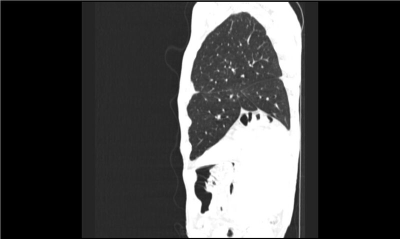 File:Aspergilloma (Radiopaedia 20788-20701 Sagittal lung window 17).jpg
