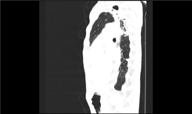 File:Aspergilloma (Radiopaedia 20788-20701 Sagittal lung window 8).jpg