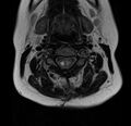 Astrocytoma - spinal cord (Radiopaedia 69769-79758 Axial T2 9).jpg