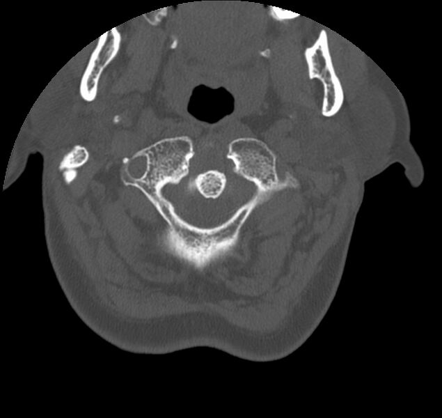 File:Atlanto-occipital assimilation with basilar invagination (Radiopaedia 70122-80188 Axial bone window 22).jpg
