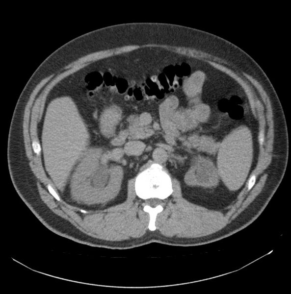 File:Atrophic kidney due to severe chronic obstructive hydronephrosis (Radiopaedia 40828-43474 Axial non-contrast 3).jpg