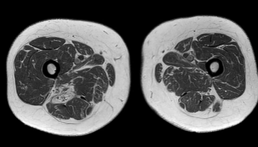 Atypical lipomatous tumor - thigh (Radiopaedia 68975-78734 Axial T1 60).jpg