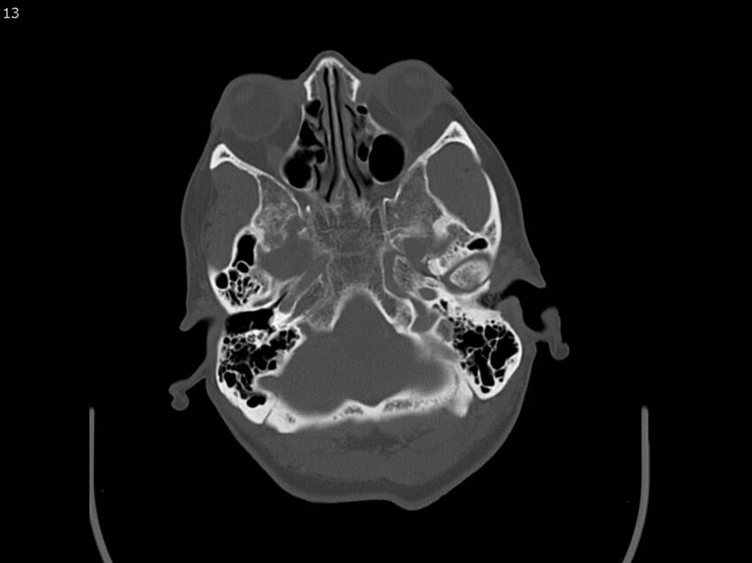 Atypical meningioma - intraosseous (Radiopaedia 64915-73867 Axial C+ bone window 13).jpg