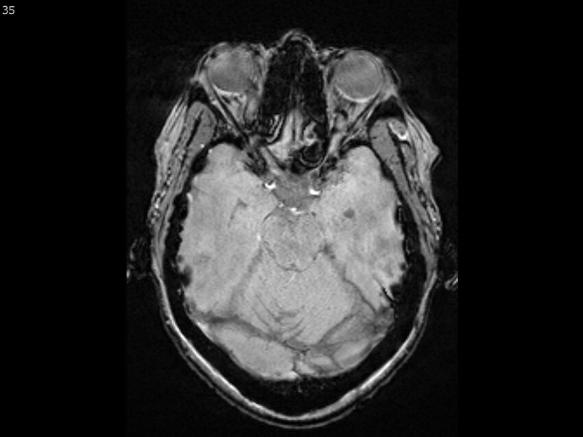 Atypical meningioma - intraosseous (Radiopaedia 64915-74572 Axial SWI 35).jpg