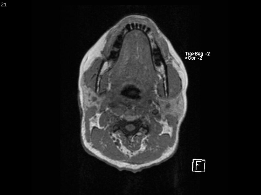 Atypical meningioma - intraosseous (Radiopaedia 64915-74572 Axial T1 21).jpg