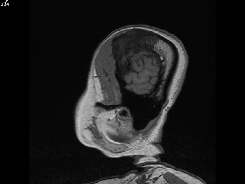 Atypical meningioma - intraosseous (Radiopaedia 64915-74572 Sagittal T1 134).jpg