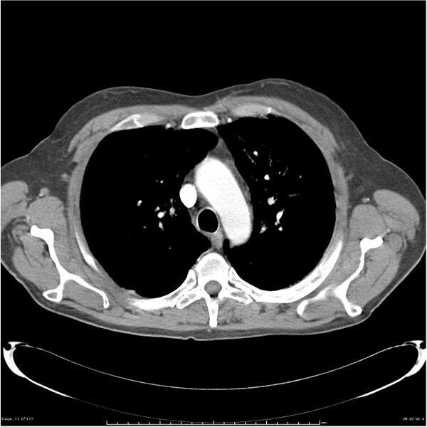 File:Atypical pneumonia - Q fever (Radiopaedia 21993-21989 C+ arterial phase 13).jpg