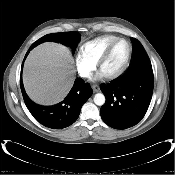 File:Atypical pneumonia - Q fever (Radiopaedia 21993-21989 C+ arterial phase 36).jpg