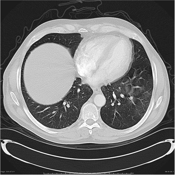 File:Atypical pneumonia - Q fever (Radiopaedia 21993-21989 lung window 33).jpg