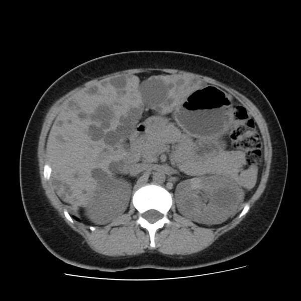 File:Autosomal dominant polycystic kidney disease (Radiopaedia 23061-23093 Axial non-contrast 21).jpg