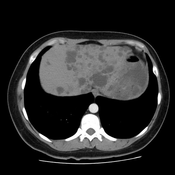 File:Autosomal dominant polycystic kidney disease (Radiopaedia 23061-23093 B 10).jpg