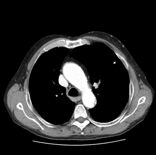 File:Autosomal dominant polycystic kidney disease (Radiopaedia 27851-28094 B 21).jpg