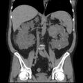Autosomal dominant polycystic kidney disease (Radiopaedia 36539-38101 C 39).jpg