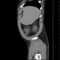 Autosomal dominant polycystic kidney disease (Radiopaedia 36539-38101 D 11).jpg