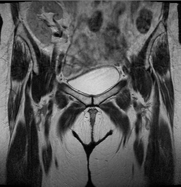 File:Avascular necrosis of the hip in renal transplant patient (Radiopaedia 7383-8236 C 1).jpg