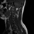 Axis fracture - MRI (Radiopaedia 71925-82375 Sagittal T1 1).jpg