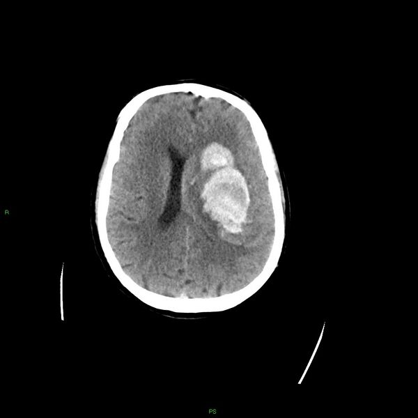 File:Basal ganglia hemorrhage (Radiopaedia 58349-65472 Axial non-contrast 25).jpg