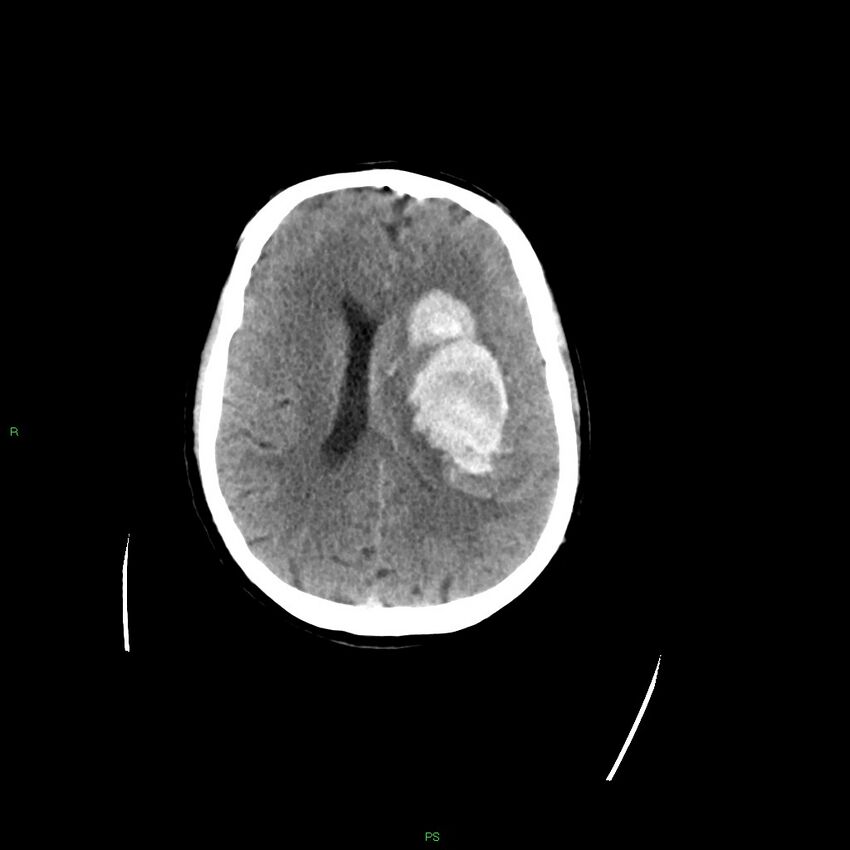 Basal ganglia hemorrhage (Radiopaedia 58349-65472 Axial non-contrast 25).jpg