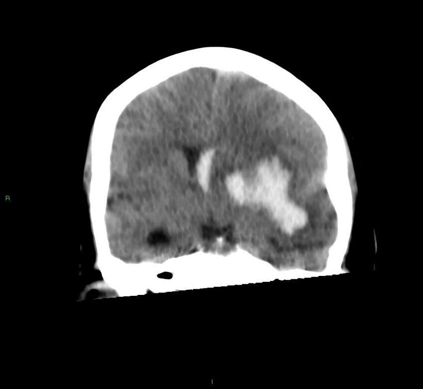 Basal ganglia hemorrhage (Radiopaedia 58759-65981 Coronal non-contrast 42).jpg