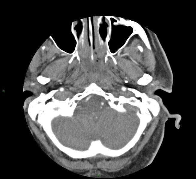 File:Basal ganglia hemorrhage (Radiopaedia 58763-65985 D 26).jpg