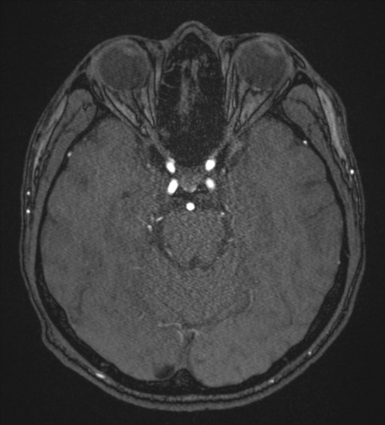 File:Basal ganglia subacute infarct (Radiopaedia 80201-93521 Axial MRA 43).png