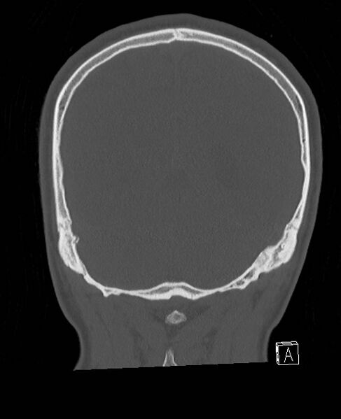 File:Base of skull fracture with bilateral Le Fort fractures (Radiopaedia 47094-51638 Coronal bone window 24).jpg