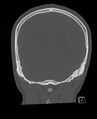 Base of skull fracture with bilateral Le Fort fractures (Radiopaedia 47094-51638 Coronal bone window 24).jpg