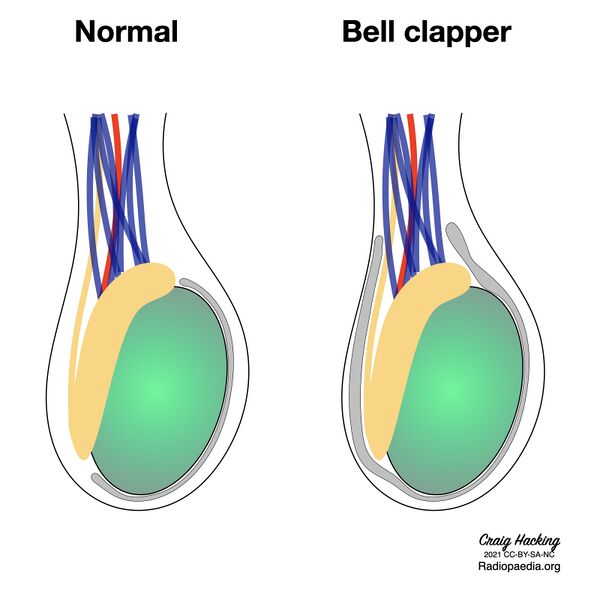 File:Bell clapper deformity (diagram) (Radiopaedia 86124-102079 G 1).jpeg
