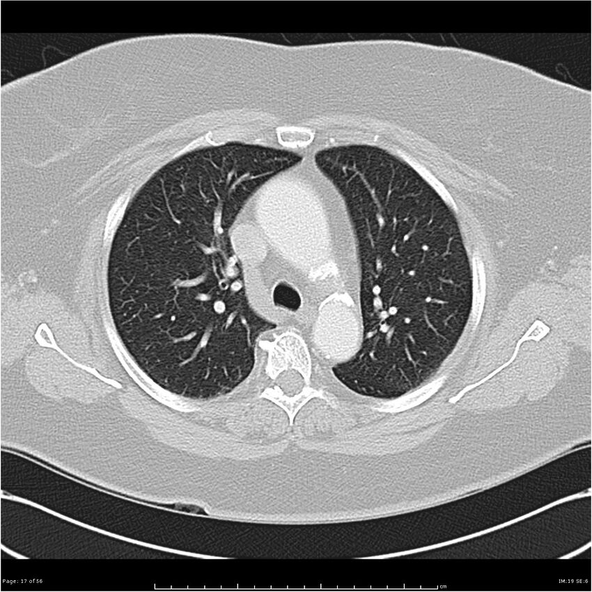 Benign metastasizing leiomyoma (Radiopaedia 26803-26962 Axial lung window 17).jpg