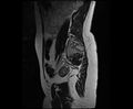 Bicornuate bicollis uterus (Radiopaedia 61626-69616 Sagittal T2 31).jpg