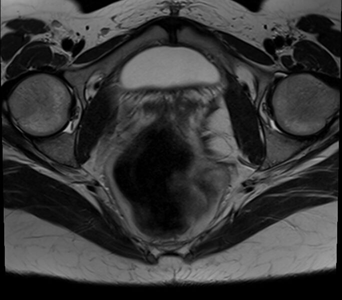 File:Bicornuate uterus (Radiopaedia 71214-81511 Axial T2 10).jpg
