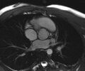 Bicuspid aortic valve with aortic coarctation (Radiopaedia 29895-30410 Oblique SSFP Cine 1).jpg