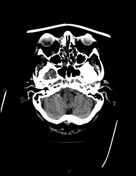 File:Bilateral acute middle cerebral artery territory infarcts (Radiopaedia 77319-89401 Axial non-contrast 14).jpg