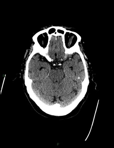 File:Bilateral acute middle cerebral artery territory infarcts (Radiopaedia 77319-89401 Axial non-contrast 29).jpg