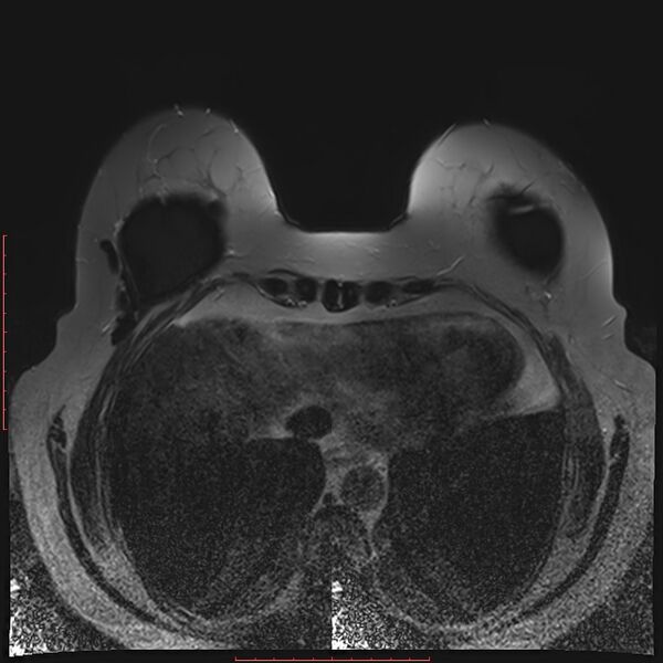 File:Bilateral breast implant rupture (Radiopaedia 24761-25027 T2 fat sat 29).jpg