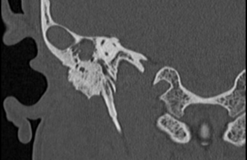File:Bilateral cholesteatoma (Radiopaedia 54898-61172 Coronal bone window 56).jpg