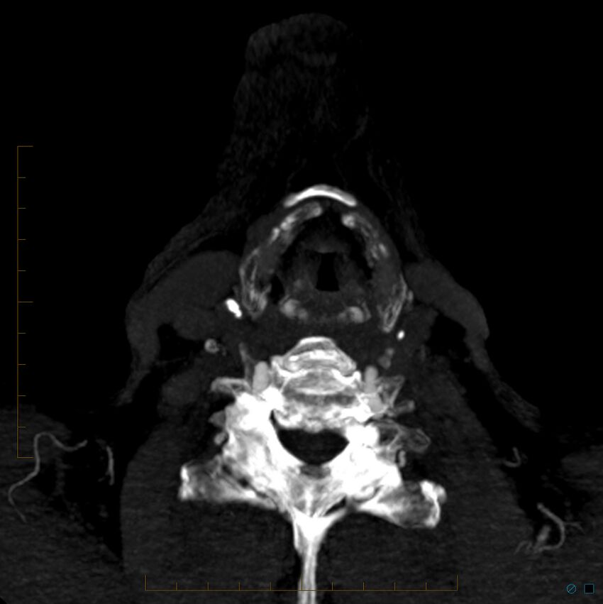 Bilateral chronic common carotid occlusion (Radiopaedia 50849-56362 D 44).jpg