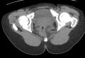 Bilateral mature cystic ovarian teratoma (Radiopaedia 88821-105592 Axial non-contrast 52).jpg